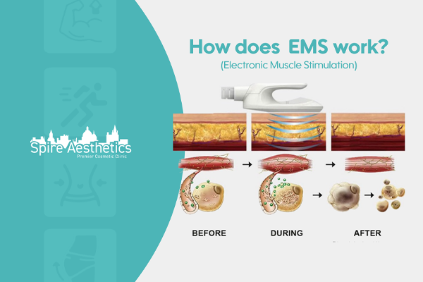 EMS treatment for post pregnancy weight loss treatment Eynsham