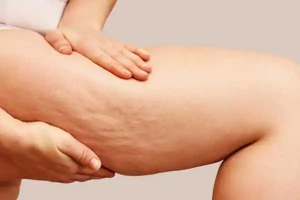 Image of woman showing leg with cellulite Eynsham