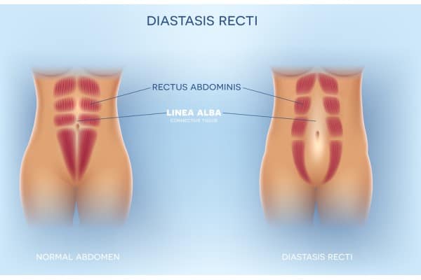 What Non-Surgical Options Are Available for Diastasis Recti Eynsham?