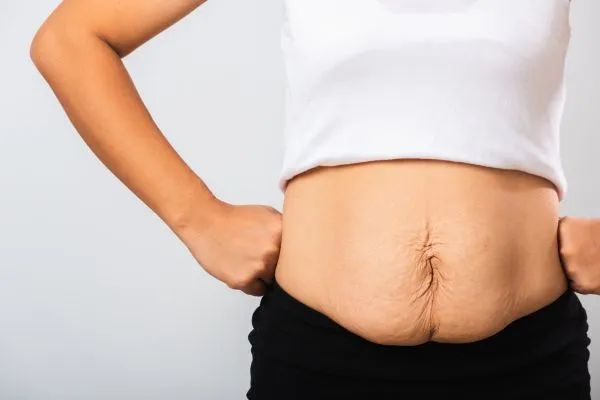 Image of a woman's stomach after weight loss with sagging skin following a gastric band Eynsham