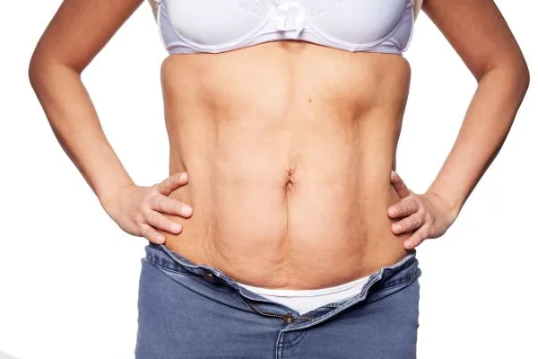 sagging skin on woman's stomach after weight loss injections Eynsham