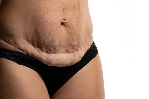 Image of womans stomach after weight loss injections Eynsham showing saggy skin