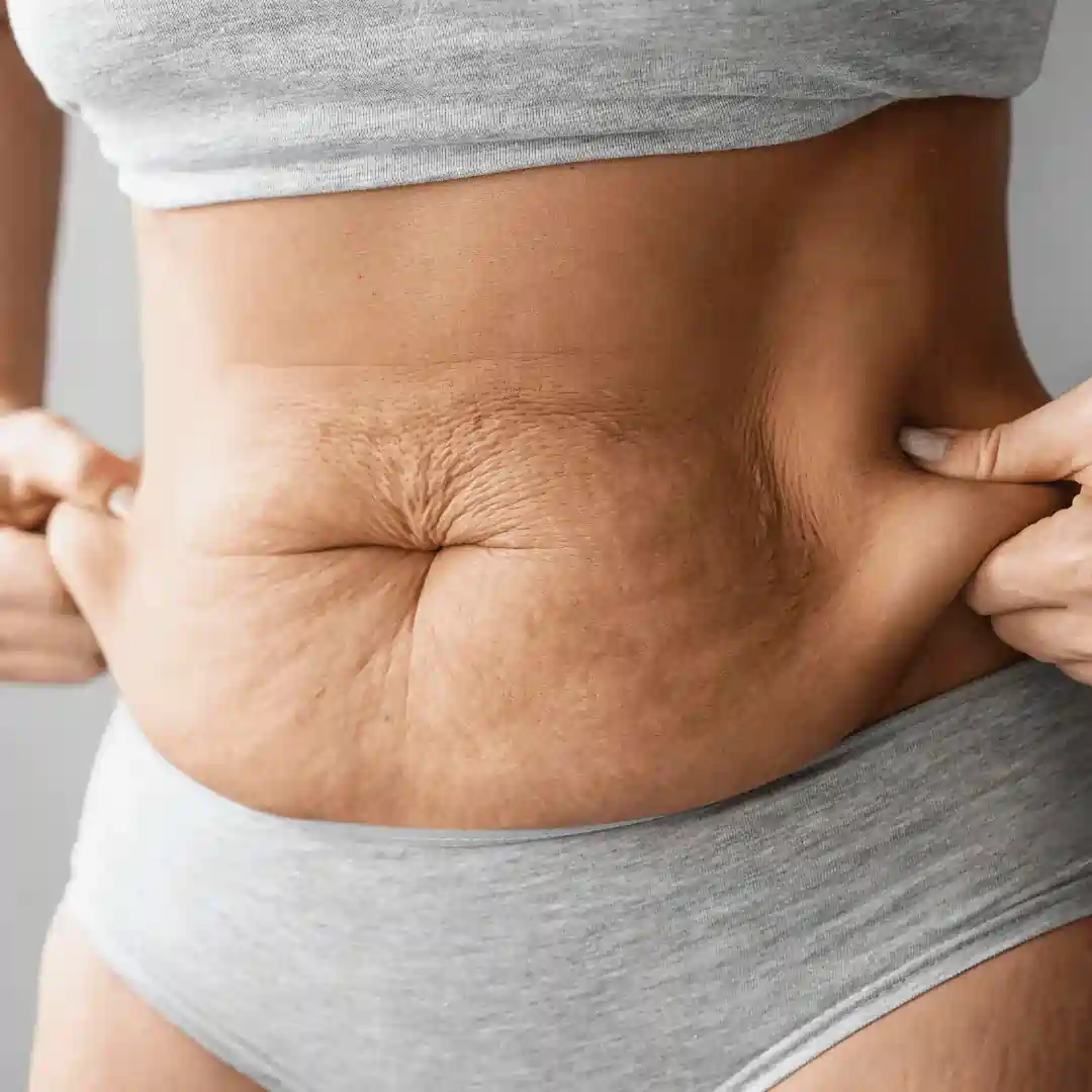 Is It Normal to Have Loose Skin After Pregnancy Eynsham?