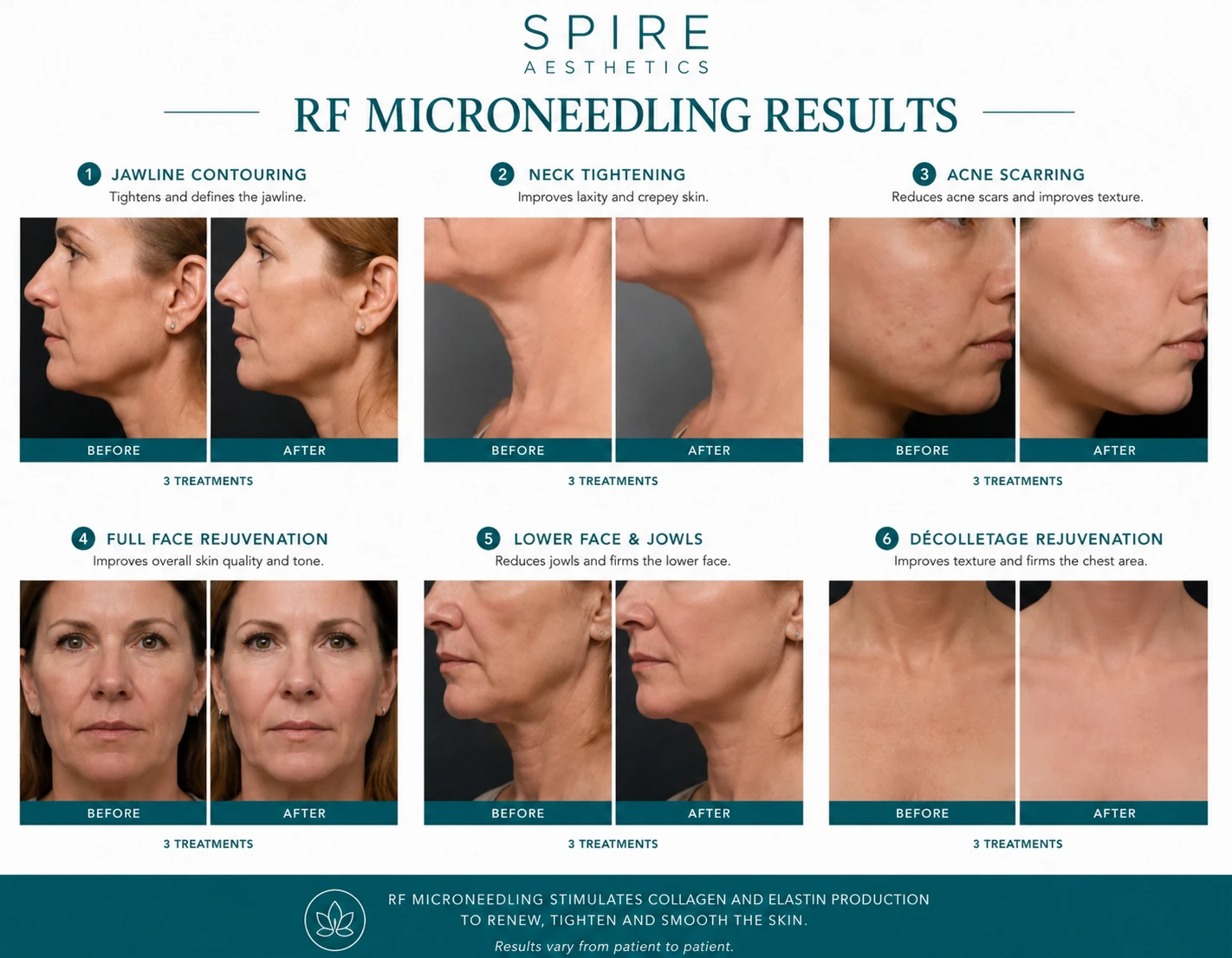 RF Microneedling Skin tightening Eynsham results