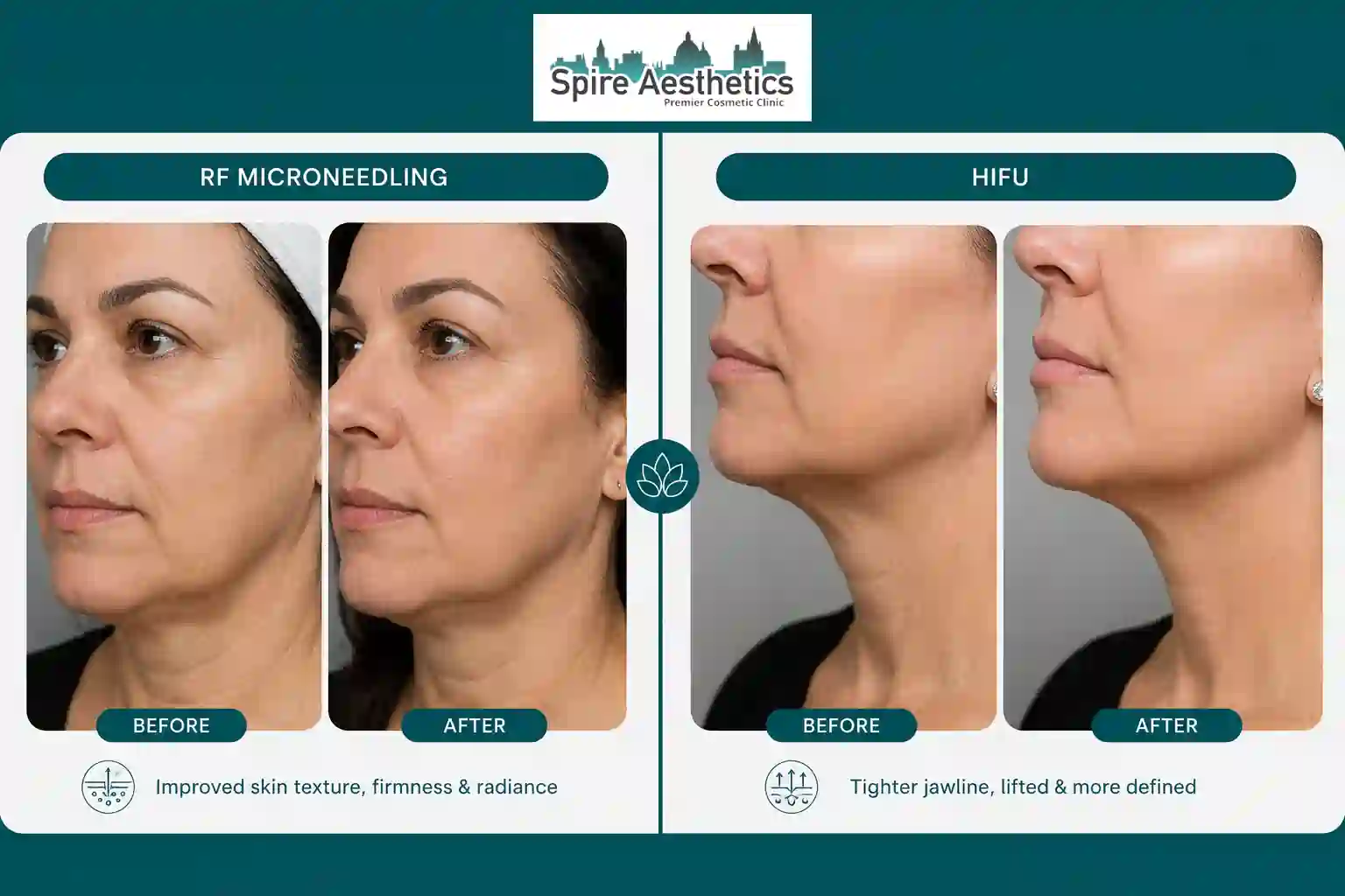 Can RF Microneedling and HIFU Be Combined Eynsham?