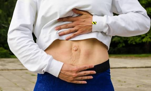 When Could Diastasis Recti Be the Missing Piece of the Puzzle Eynsham?
