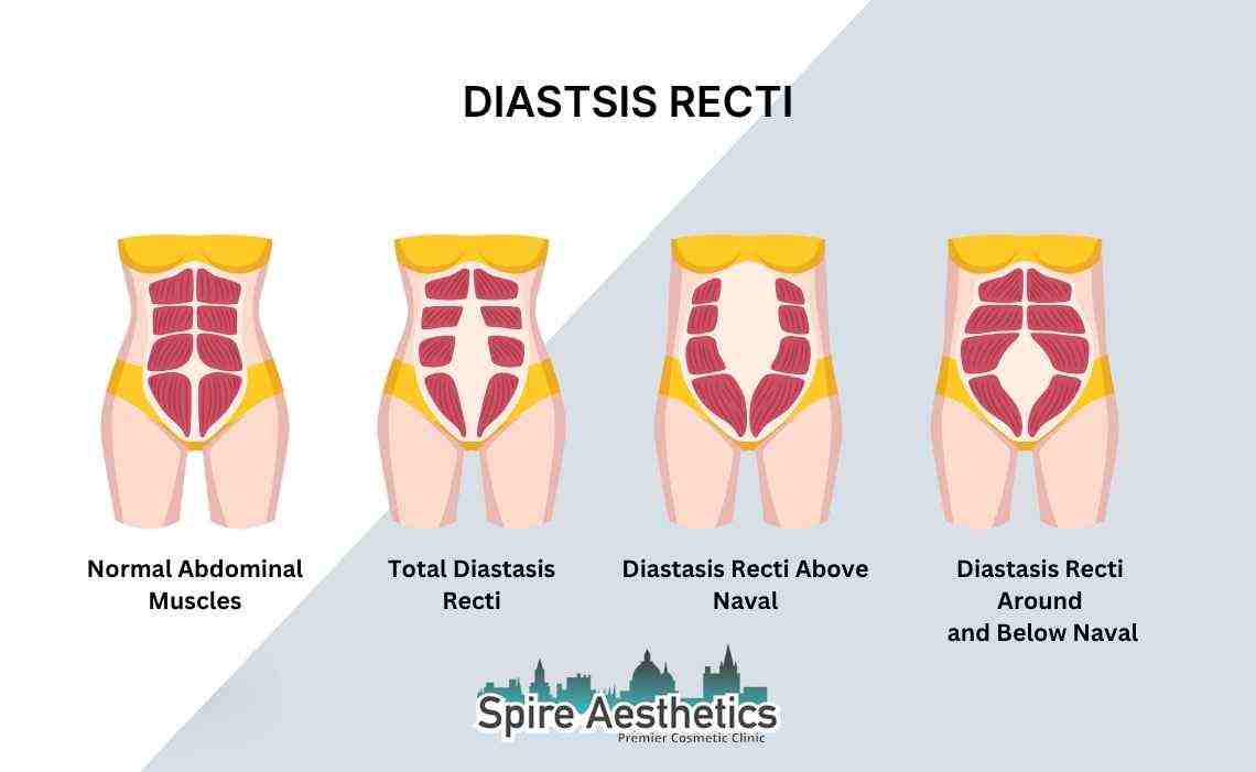 Is Non-Surgical Diastasis Recti Treatment Right for You? Common Concerns Answered Eynsham